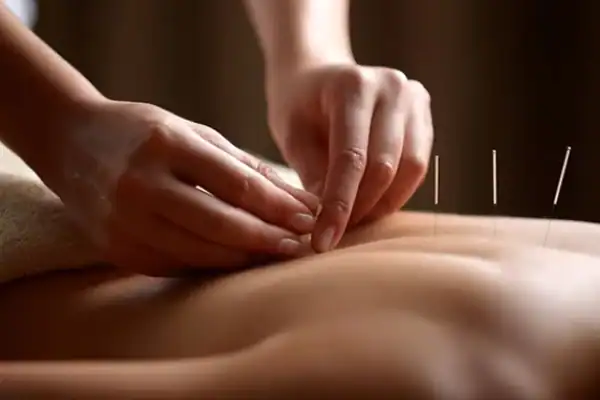 Acupuncture needles applied on person's back.