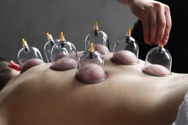 Cupping therapy with suction cups on a back.
